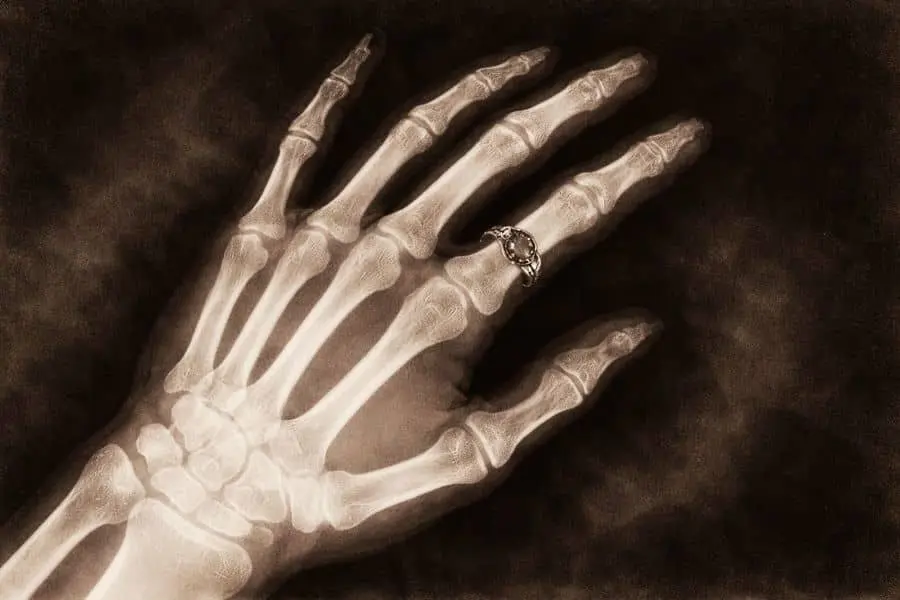 first X-ray image hand Wilhelm Röntgen discovery story historical scan 